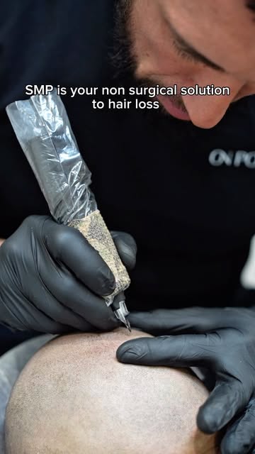 Looking for a quick fix for hair loss? SMP is it! 

•No surgery
•No downtime 
•No pain 

Just great 