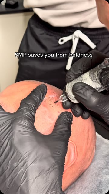 SMP solves hairloss 🔥

No surgery
No downtime
No worries 

Book a complimentary consultation with u
