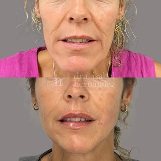 ✨Full face integral ✨

Nuestra bella paciente nos ha visitado para mejorar el aspecto en general del
