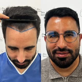 ✨Cirugía frontal y Redensificación 6 meses. Implante en patillas de barba ✨

Una cirugía muy estétic