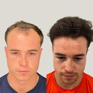 ✨Cirugía frontal y Redensificación 12 meses ✨

Nuestro paciente Alejandro acudió a nuestra consulta 