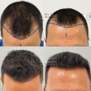 ✨Reconstruccion frontal ✨ 🌱 6 meses

Nuestro paciente acudió a consulta con el objetivo de mejorar 