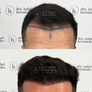 ✨Reconstruccion frontal ✨ 🌱 6 meses. 

Nuestro paciente acudió a consulta con el objetivo de mejora