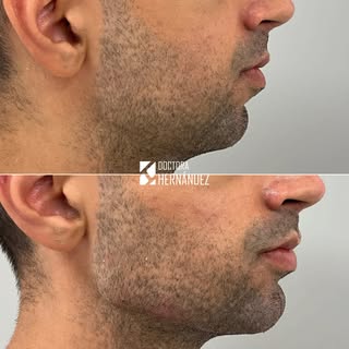Armonización facial masculina.

En este paciente trabajamos el tercio medio, buscando reposicionar y