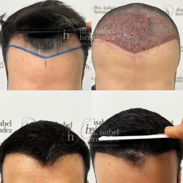 ✨Reconstruccion frontal ✨ 🌱 6 meses. Nos quedan 6 meses más. 

Nuestro paciente acudió a consulta c
