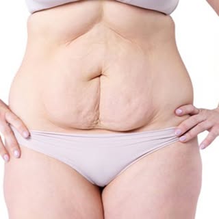 Loose skin after weight loss: when non surgical treatments work- and when they don’t. https://bit.ly