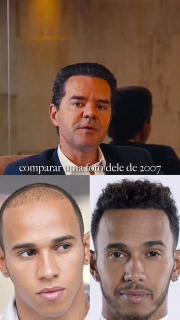 Lewis Hamilton, David Beckham, Tom Brady. A internet especula há anos se eles fizeram transplante ca