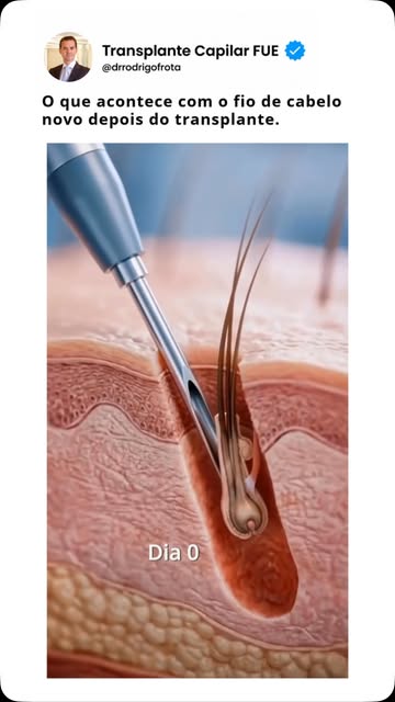 Depois do transplante, o fio passa por etapas diferentes até o novo crescimento começar.
Nos primeir