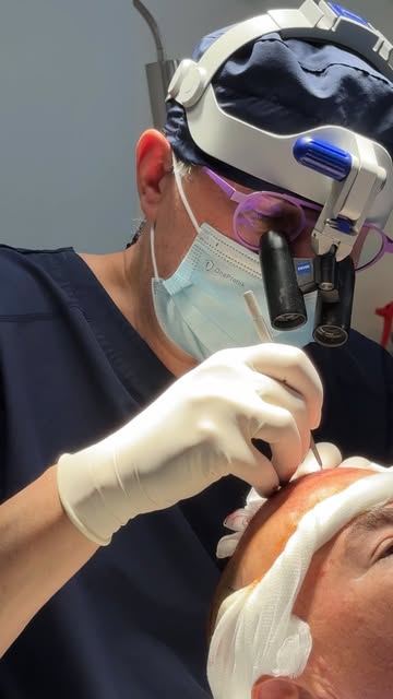 La technique non shaved permet de réaliser une greffe FUE sans raser ni la zone donneuse, ni la zone