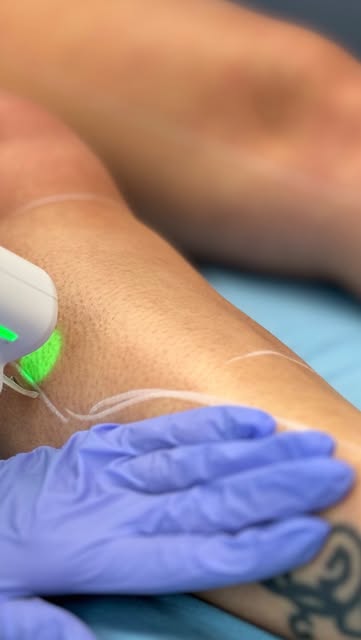 Est-ce que l’épilation laser fait mal ? 

Sensation de chaleur, petits picotements… la perception va