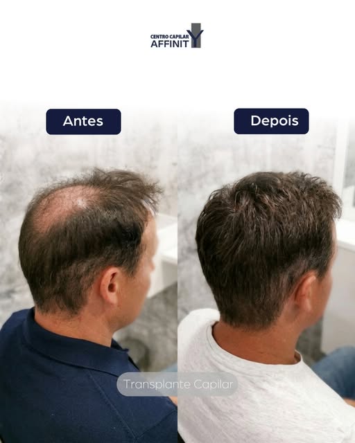 Muitos acreditam que o transplante capilar é um resultado imediato, mas a verdadeira beleza está em 