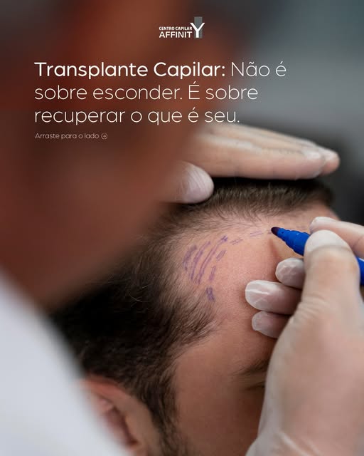 Muitas vezes, a perda de cabelo traz consigo uma perda de autoconfiança. Por isso, nosso trabalho aq
