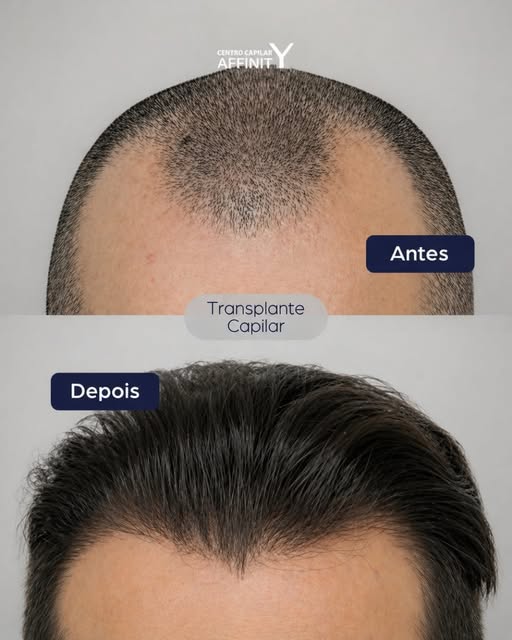 A arte de reconstruir a moldura do rosto. ✨

Neste caso, o desafio era reverter as falhas na região 