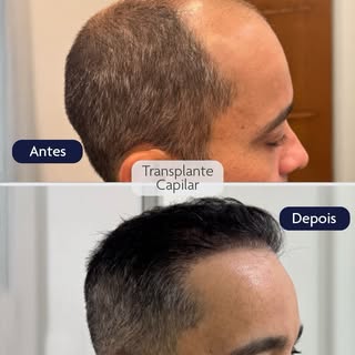 Uma transformação planejada para um caso de calvície extensa - grau 6, com foco em recuperar a harmo