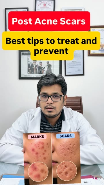#dermacliniquemohali #dermatologist #skincare #acneproneskin #acne scar treatment  Why do they occur
