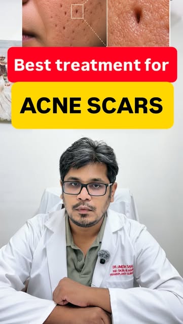 #dermacliniquemohali #dermatologist #acne #acne scar treatment #Here’s a simple, reel-friendly note: