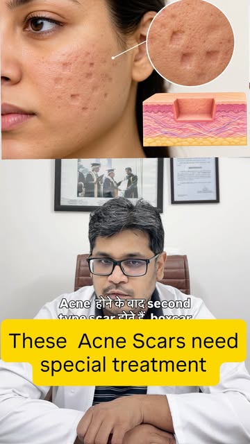 #acnescartreatment #acnescarring #dermacliniquemohali #drumeshsahu #Boxcar scars are depressed acne 