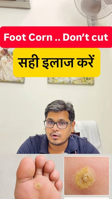 #dermatologist #dermacliniquemohali #drumeshsahu #hairtransplantmohali # corn in footCorn on the Foo