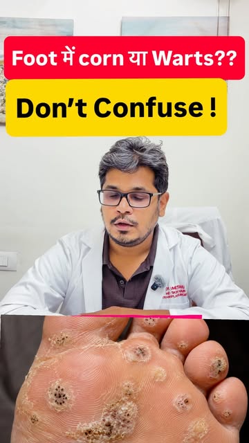 #dermacliniquemohali #dermatologist #drumeshsahu #foot corn/ foot warts.  Plantar Warts — Quick Fact