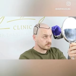 👨‍⚕️Expert Ugur YAVUZ has successfully treated thousands of patients in the hair transplant industr