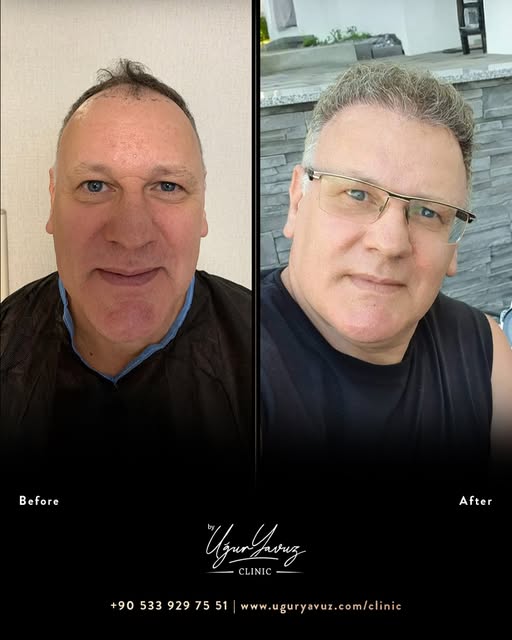 A hair transplant doesn’t just change your appearance—it rejuvenates your confidence and spirit! 💫 