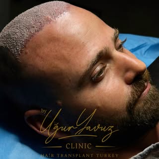 #hairtransplant