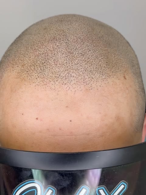 1st session instant results!! This is why SMP is such a great alternative for hair replacement/ enha