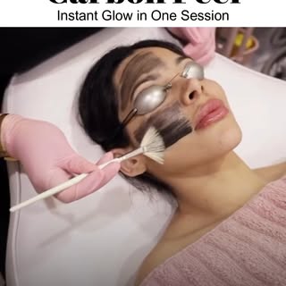 Get radiant, glowing skin in just 1 session with our Carbon Peel Treatment! ✨ Say goodbye to dull sk