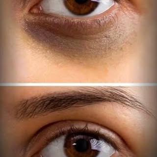Say goodbye to stubborn dark circles! 👁️

Dark circles can be caused by pigmentation, aging, volume