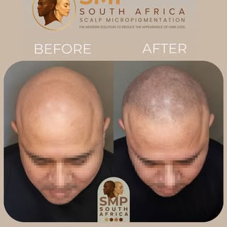 The transformation goes way beyond the hairline, it's all about bringing back that original confiden