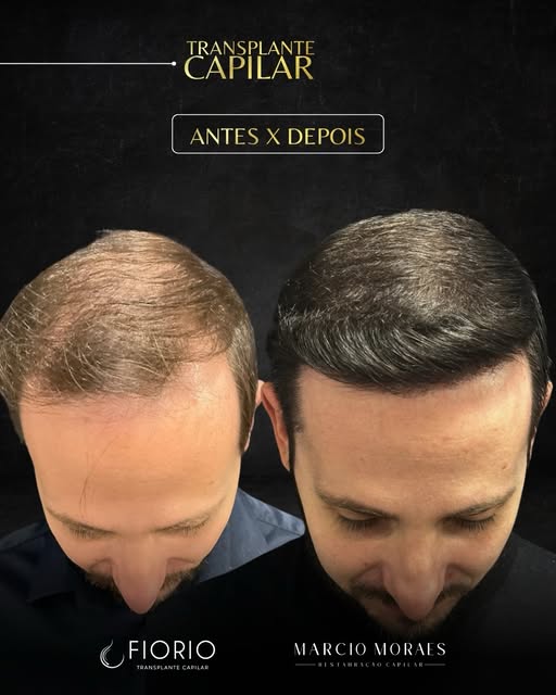 Quando ele nos procurou, tinha um objetivo especial: queria se sentir melhor com o próprio cabelo pa