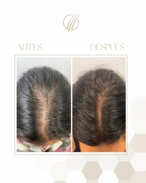 Resultados que hablan de evolución 🤍

Este es el antes y después de una paciente con alopecia andro
