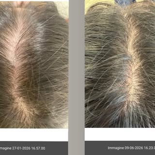 Terapia tricologica personalizzata.
Risultato dopo 5 mesi.