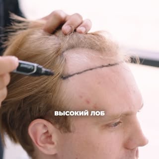 Очередной кейс пересадки волос, по всем вопросам пишите на вотсап либо директ ☎️8-775-755-1221

Лице