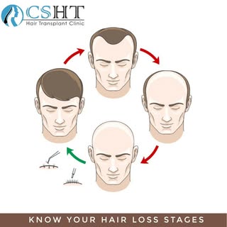 Know your hair loss stages.
#hairtransplant #hairloss #hair #hairrestoration #fue #scalptattoo #alop