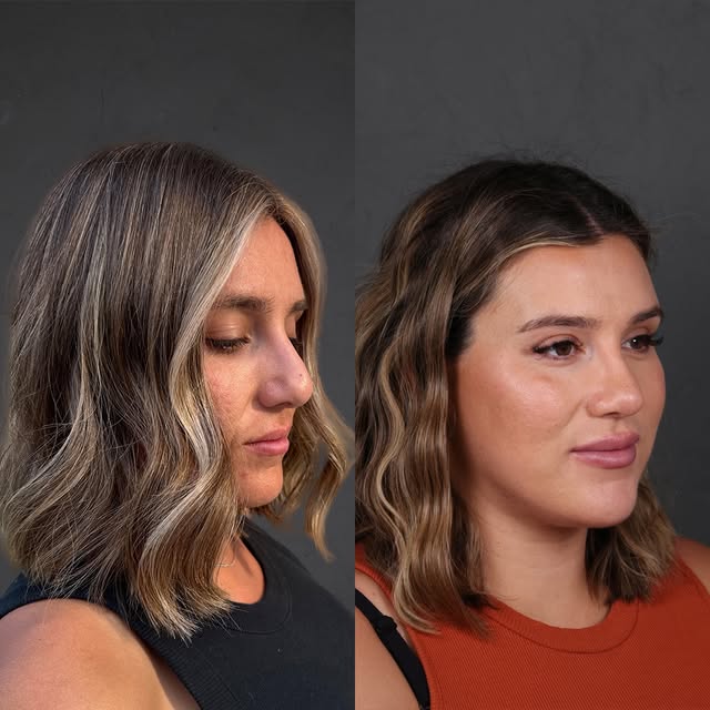 Over one year out from her complex revision rhinoplasty- and due to have a baby soon! We performed a