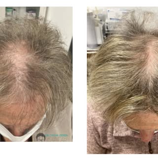 🌟 ¡Luce una barba perfecta! En Oscar Zepeda Transplante Capilar, realizamos injertos de barba para 