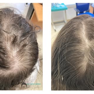 🌟 ¡Di adiós a la caída del cabello! En Oscar Zepeda Transplante Capilar, nuestro implante capilar e