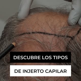 📌 Tipos de injerto capilar: ¿Cuál es el mejor para ti? 💇‍♂️✨

En este video te explicamos los prin