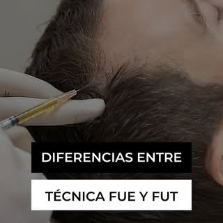 FUE vs. FUT: ¿Cuál es la mejor técnica de trasplante capilar? 💇‍♂️✨

Si estás considerando un injer