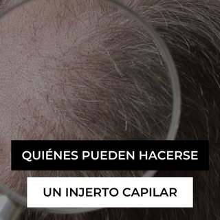 El injerto capilar es una excelente solución para la pérdida de cabello, pero no todas las personas 