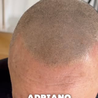 💥 TRICOPIGMENTAZIONE COMPLETA PER ADRIANO 💥
Oggi vi mostro il risultato di un lavoro che mi rende 