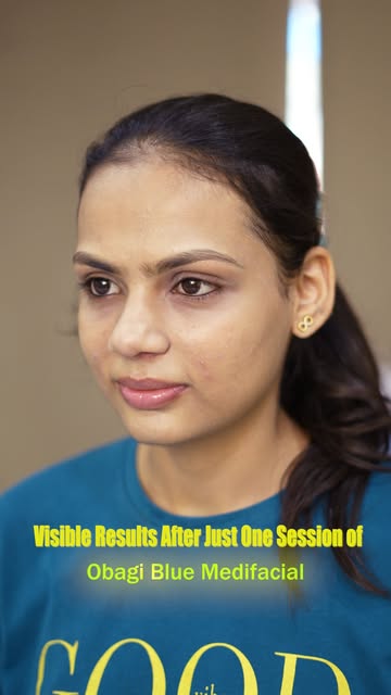 Reveal fresher, brighter and smoother-looking skin with the Obagi Blue Peel.

A professional skin tr