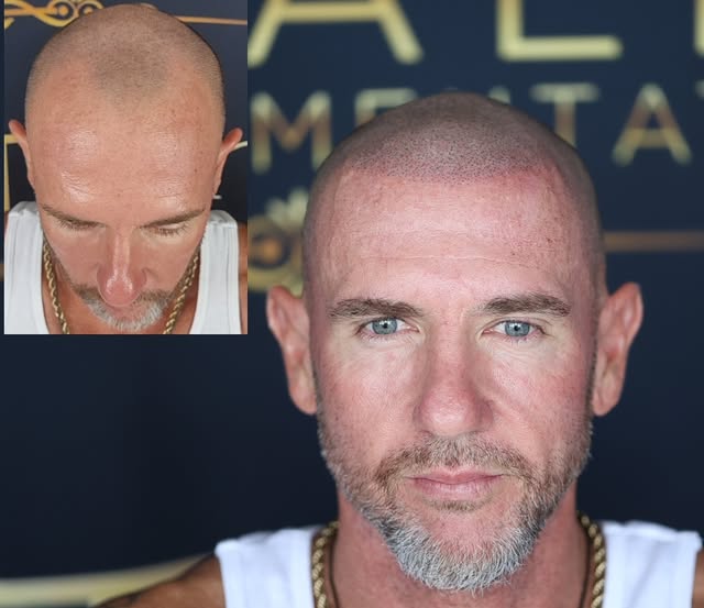 JUST A LITTLE FULLER—SO YOU’RE NO LONGER “THE BALD GUY.”

RESULTS SO NATURAL, NOT EVEN YOUR FAMILY W