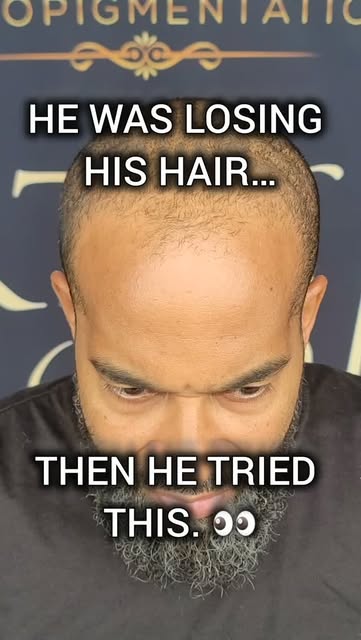 HE WAS LOSING HIS HAIR… THEN HE MADE A CHANGE. 🔥
From the BEFORE to the AFTER — this is what a prop