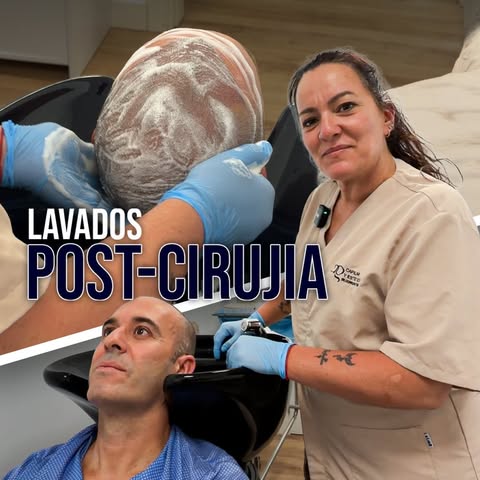 Hoy Víctor vuelve a clínica para su última cura después del injerto capilar.🙌🏽

Su objetivo era me