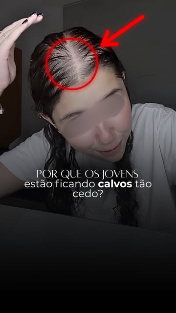 A CALVÍCIE NÃO É UM PROBLEMA EXCLUSIVO DE PESSOAS MAIS VELHAS.✨

É possível encontrar jovens apresen