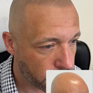 NATURAL RESULTS with Scalp Micropigmentation #smp #scalpmicropigmentation #hairloss #balding #dallas