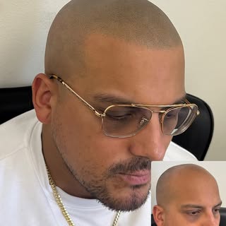 Major Transformation, so subtle and natural that nobody will notice it’s tattooed. 

#SMP #HAIRLOSS 