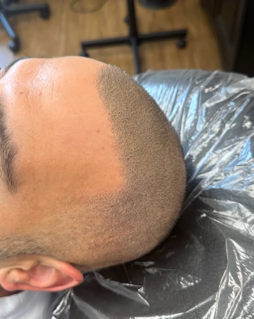 A Transplant & 3 sessions of SMP later #smp #scalpmicropigmentation #balding #hairloss #hairtranspla